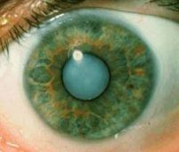 катаракта лечение народными средствами